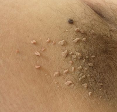 Fibroom
