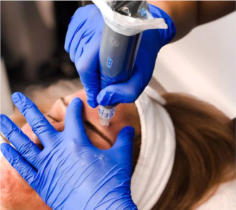Microneedling (SkinPen)