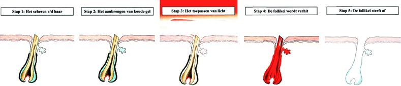 Definitief Ontharen met laser